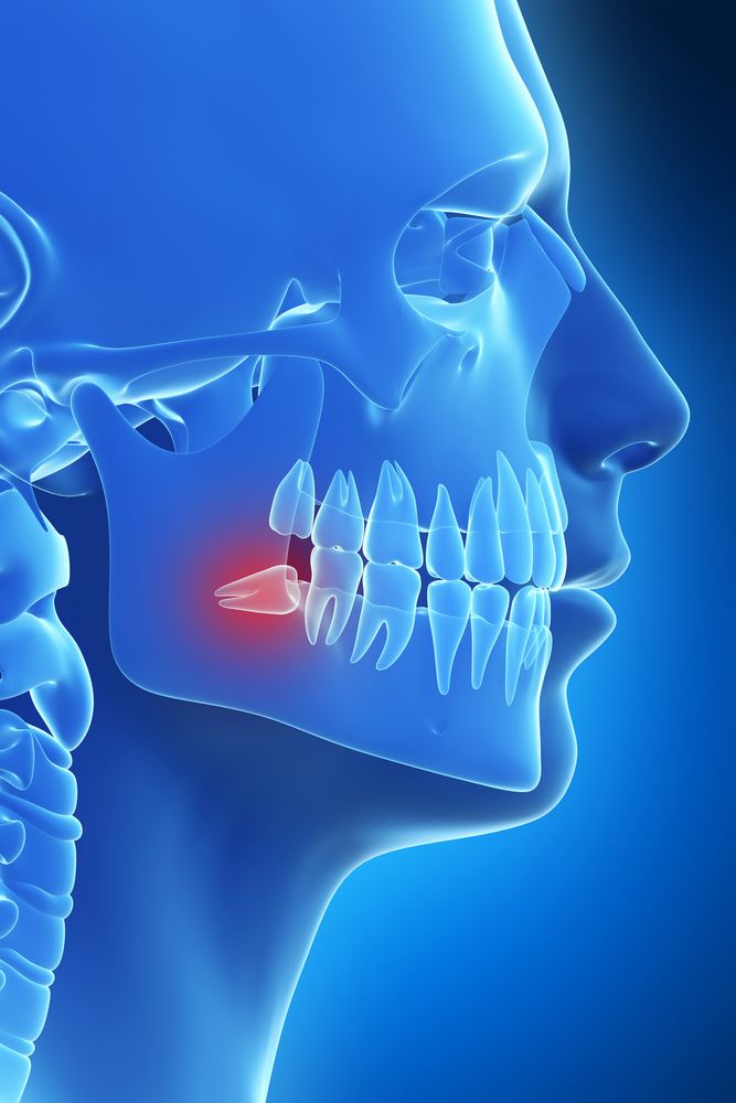 Blue graphic of jaw and skull with wisdom tooth highlighted in red