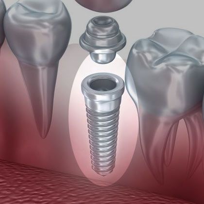 Illustration of implant and crown