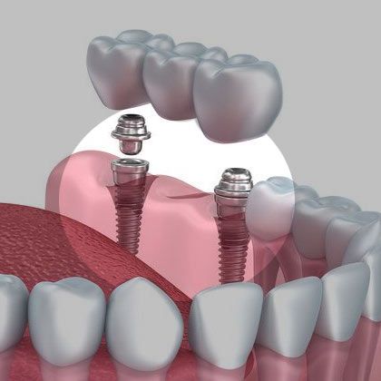 Illustration of implant bridge