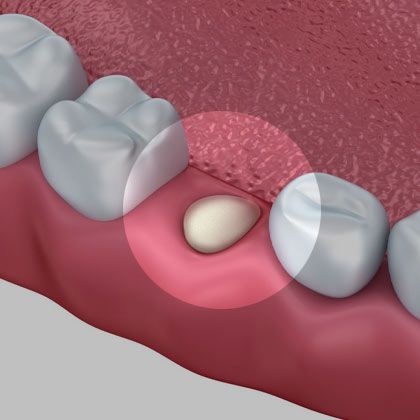 Illustration of socket preservation