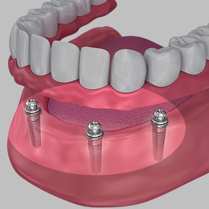 Illustration of implant denture