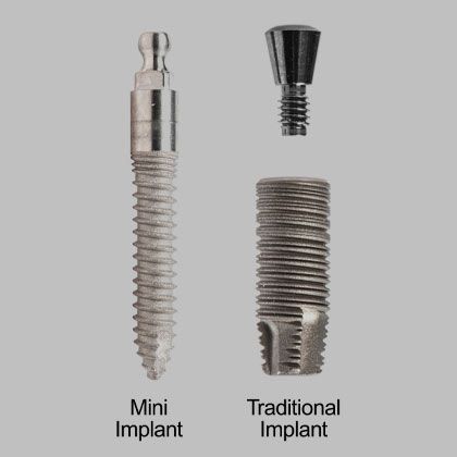 Traditional vs. mini implant