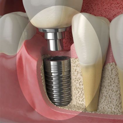 Illustration of implant in jaw