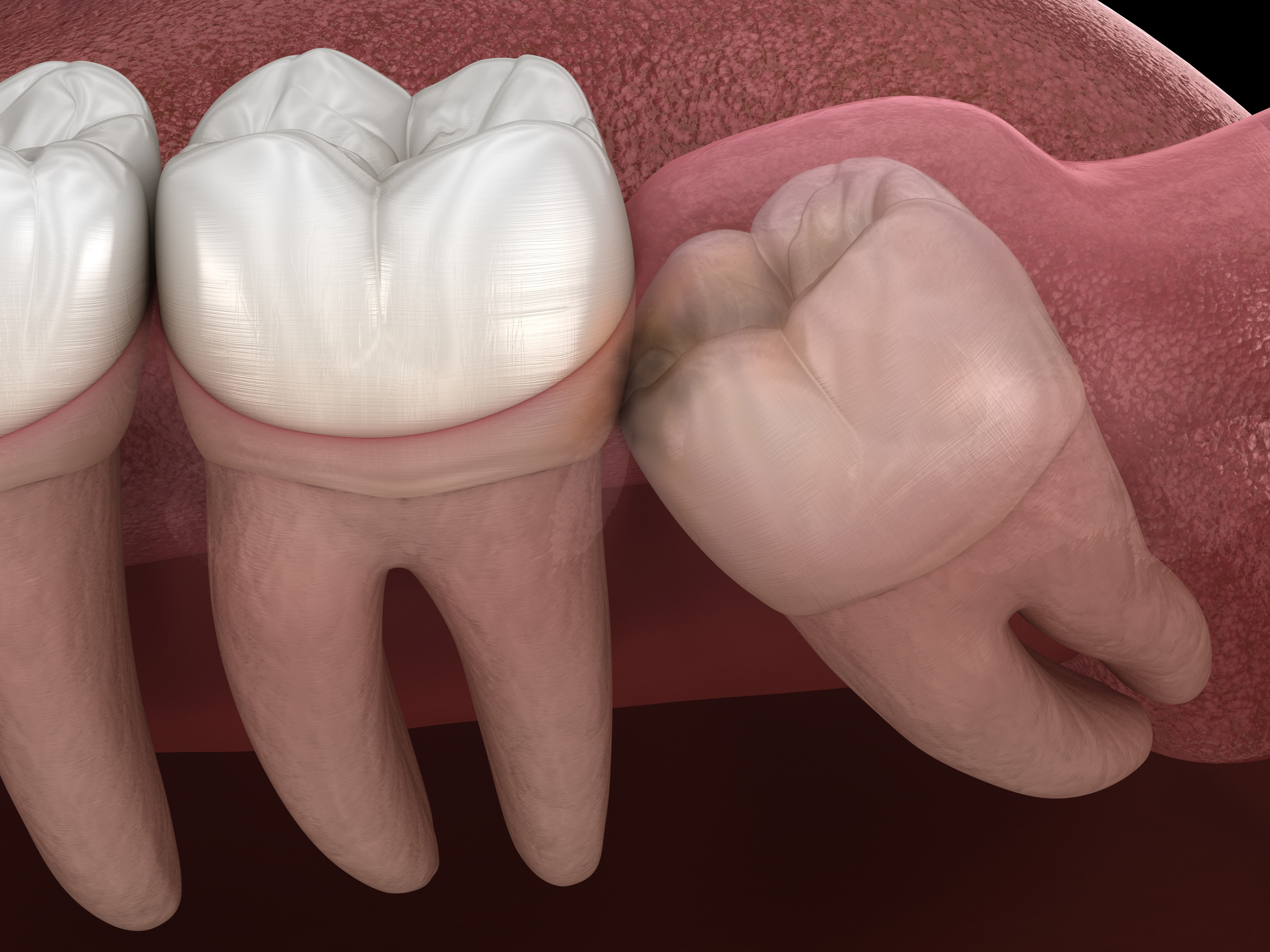 Impacted tooth pushing on nearby teeth